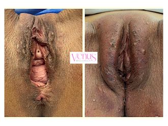 Vaginoplastia antes y después - 815969
