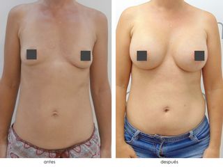 Antes y después Aumento de Pecho con prótesis Allegan redondas