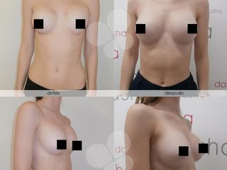 Antes y después Aumento de pecho