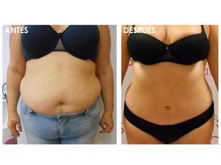 Antes y después Abdominoplastia+Liposucción