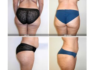 Antes y después Liposucción