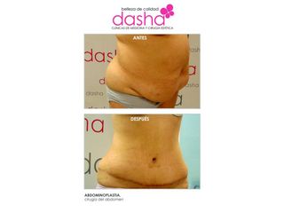 Antes y después Abdominoplastia