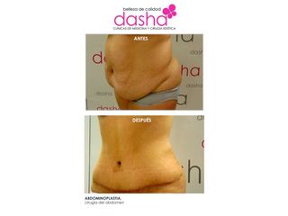 Antes y después Abdominoplastia