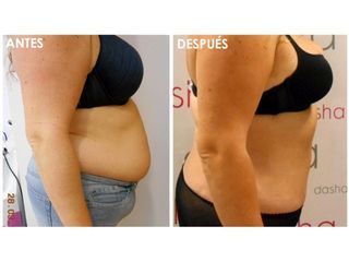 Antes y después Abdominoplastia