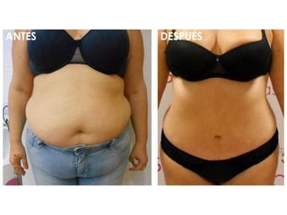 Antes y después Abdominoplastia