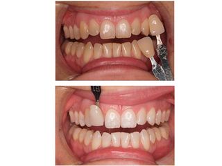 Antes y después Blanqueamiento dental