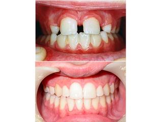 Antes y después Frenectomis y ortodoncia