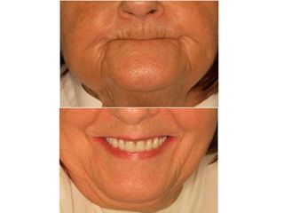 Antes y después Diseño de la sonrisa, implantología