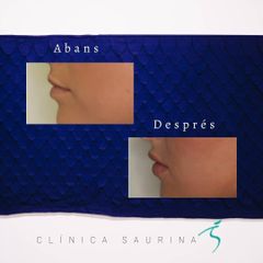 Aumento de labios - Clínica Saurina