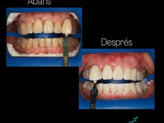 Blanqueamiento dental - 835972