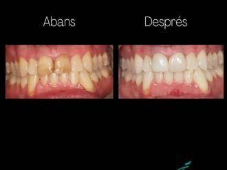 Blanqueamiento dental - 835974