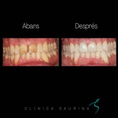 Blanqueamiento dental - Clínica Saurina