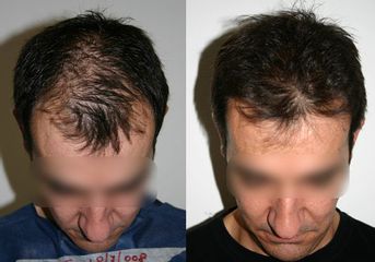Antes y después Microinjertos en un paciente con alopecia