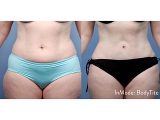 Antes y después Liposucción