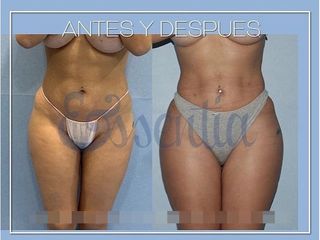Antes y después Aumento de glúteos