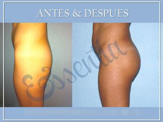 Antes y después Aumento de glúteos