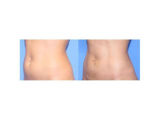 Antes y después Liposucción