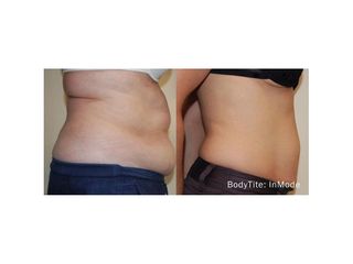 Antes y después Abdominoplastia