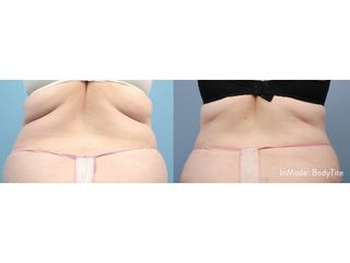 Antes y después Liposucción