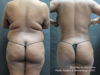 Antes y después Lipoescultura