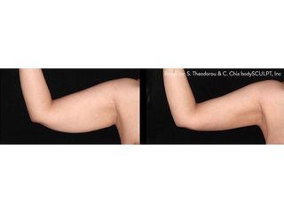 Antes y después Liposucción