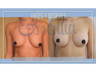 Antes y después Aumento de pecho
