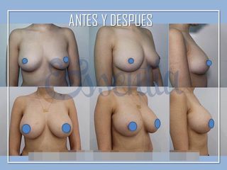 Antes y después Aumento de pecho