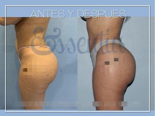 Antes y después Aumento de glúteos