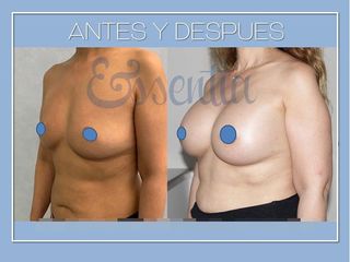 Antes y después Aumento de pecho