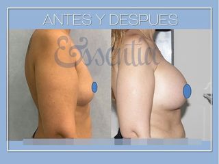 Antes y después Aumento de pecho