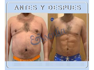 Antes y después Abdominoplastia