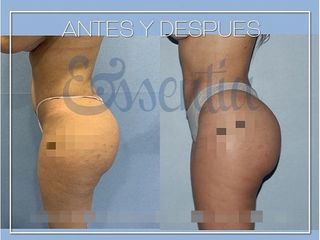 Antes y después Aumento de glúteos