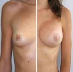 Aumento de pecho - Essentia Clinic Marbella