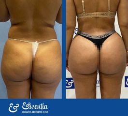 Aumento de glúteos - Essentia Clinic Marbella