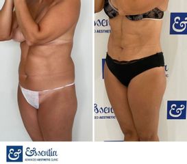 Liposucción - Essentia Clinic Marbella