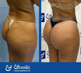 Aumento de glúteos - Essentia Clinic Marbella