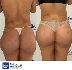 Aumento de glúteos - Essentia Clinic Marbella