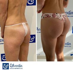 Aumento de glúteos - Essentia Clinic Marbella