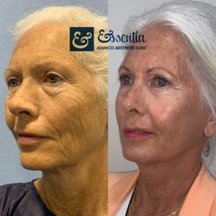 Lifting Facial - Essentia Clinic Marbella