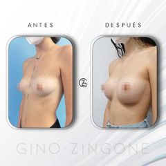Aumento de pecho - Dr. Gino Zingone