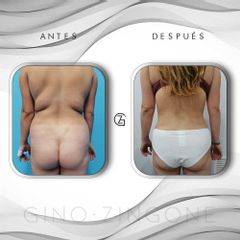 Liposucción - Dr. Gino Zingone