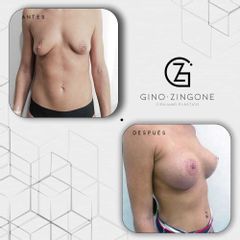 Aumento de pecho - Dr. Gino Zingone