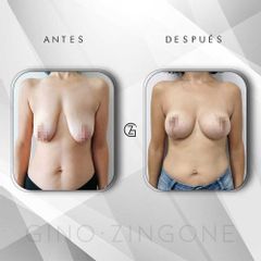 Mastopexia - Dr. Gino Zingone
