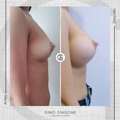 Aumento de pecho - Dr. Gino Zingone