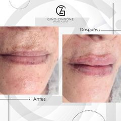 Aumento de labios - Dr. Gino Zingone