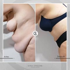 Abdominoplastia - Dr. Gino Zingone