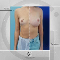 Aumento de pecho - Dr. Gino Zingone