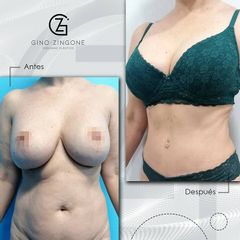 Liposucción - Dr. Gino Zingone