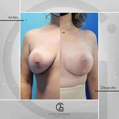 Mastopexia - Dr. Gino Zingone