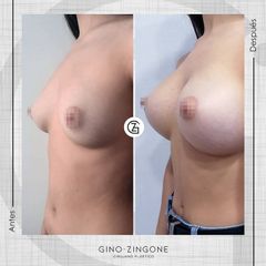 Aumento de pecho - Dr. Gino Zingone